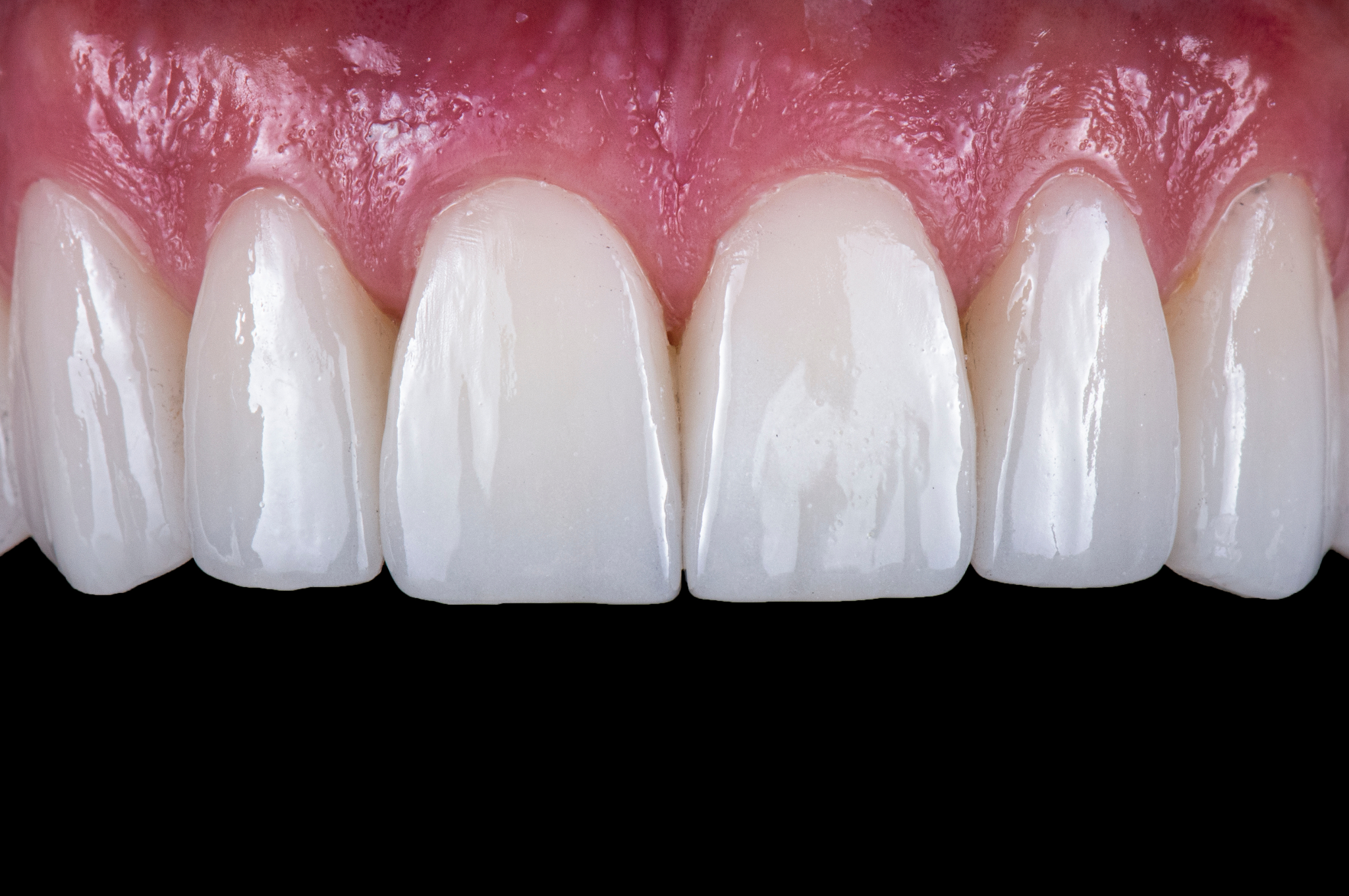 dental-veneers-white-rose-dental
