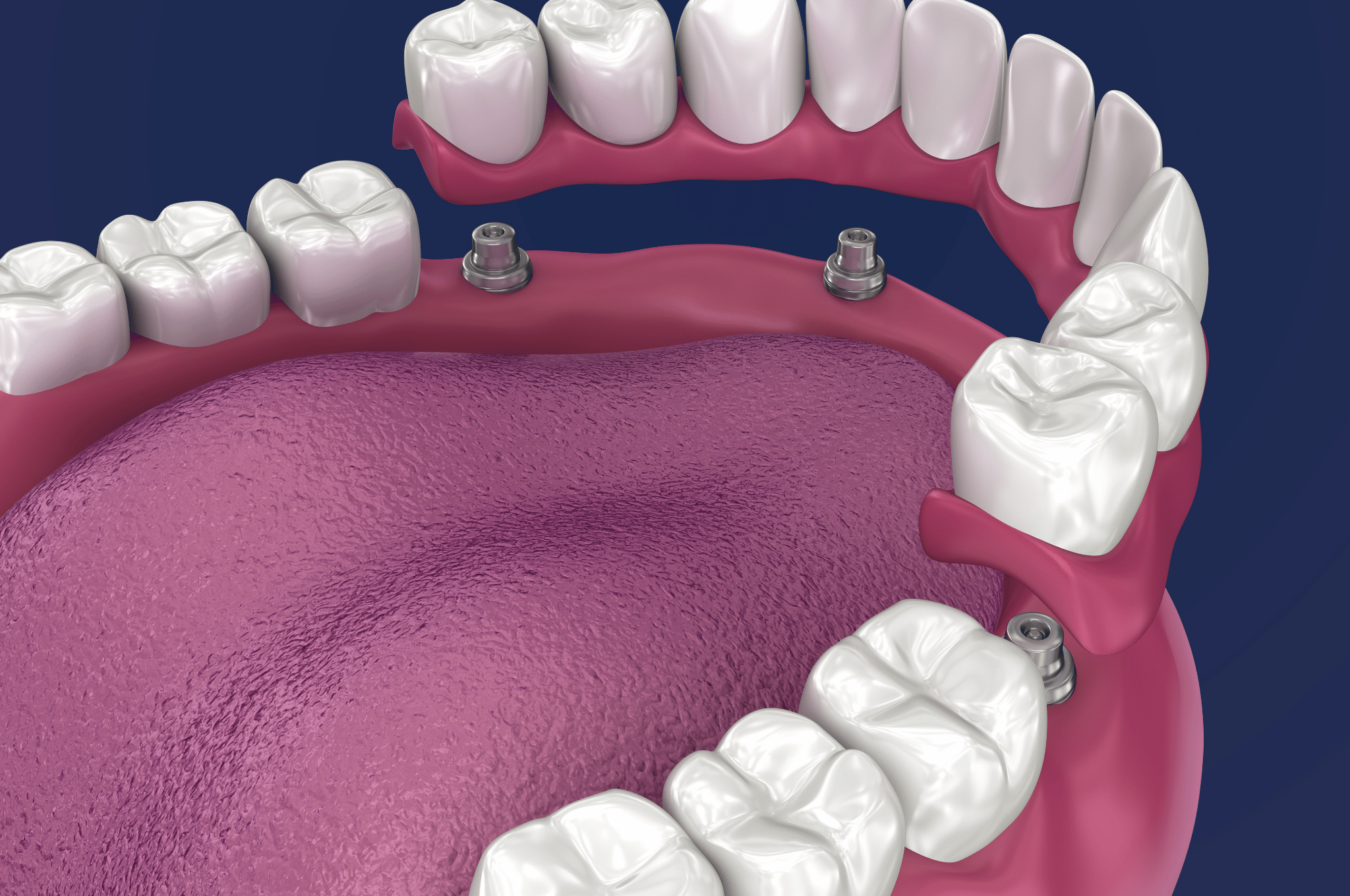 implant-supported-dentures-burlington