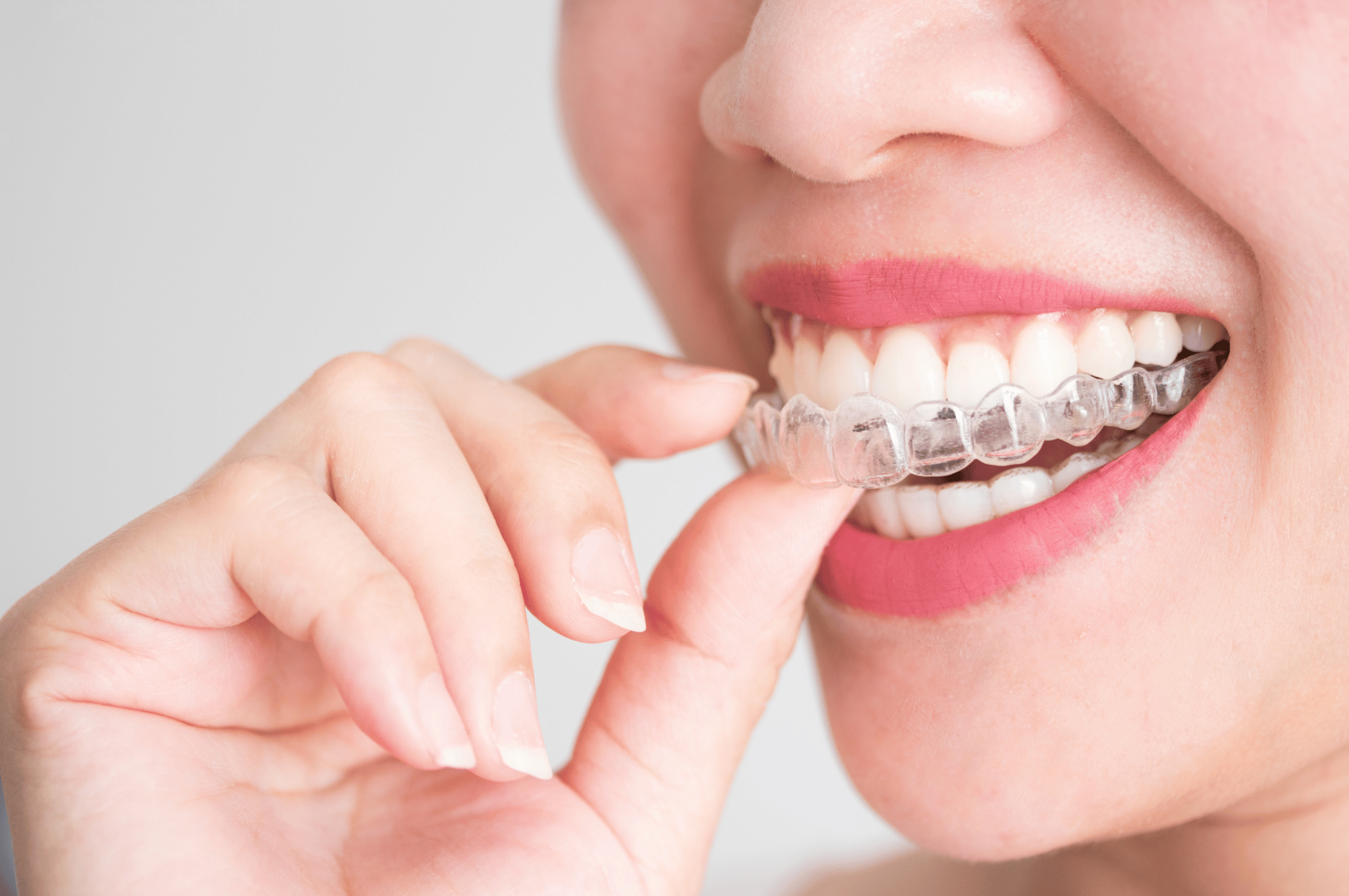 invisalign-burlington-by-white-rose-dental-studio