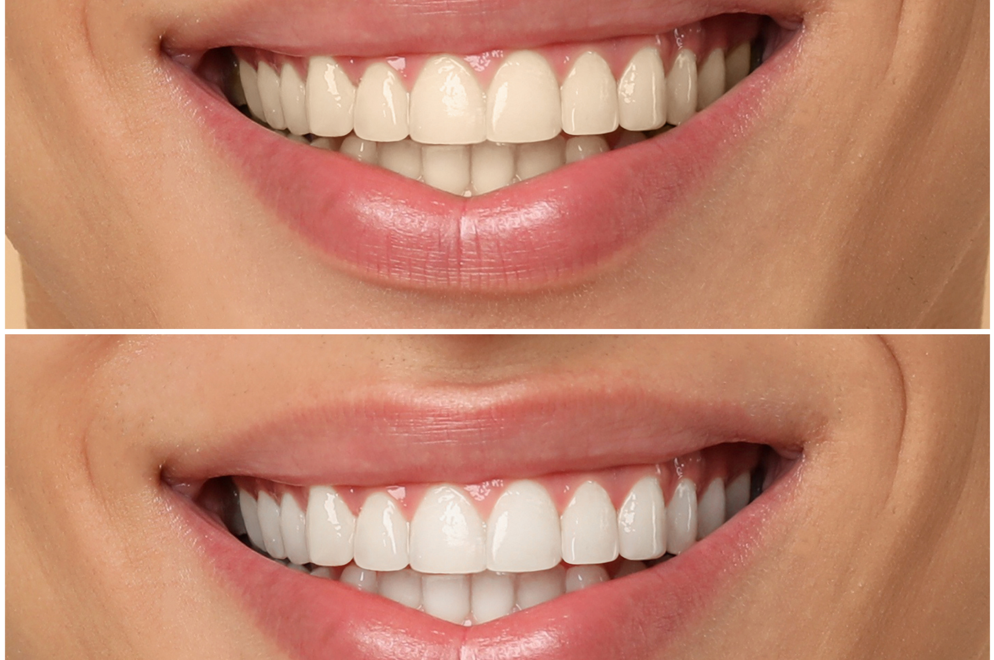 teeth-whitening-burlington