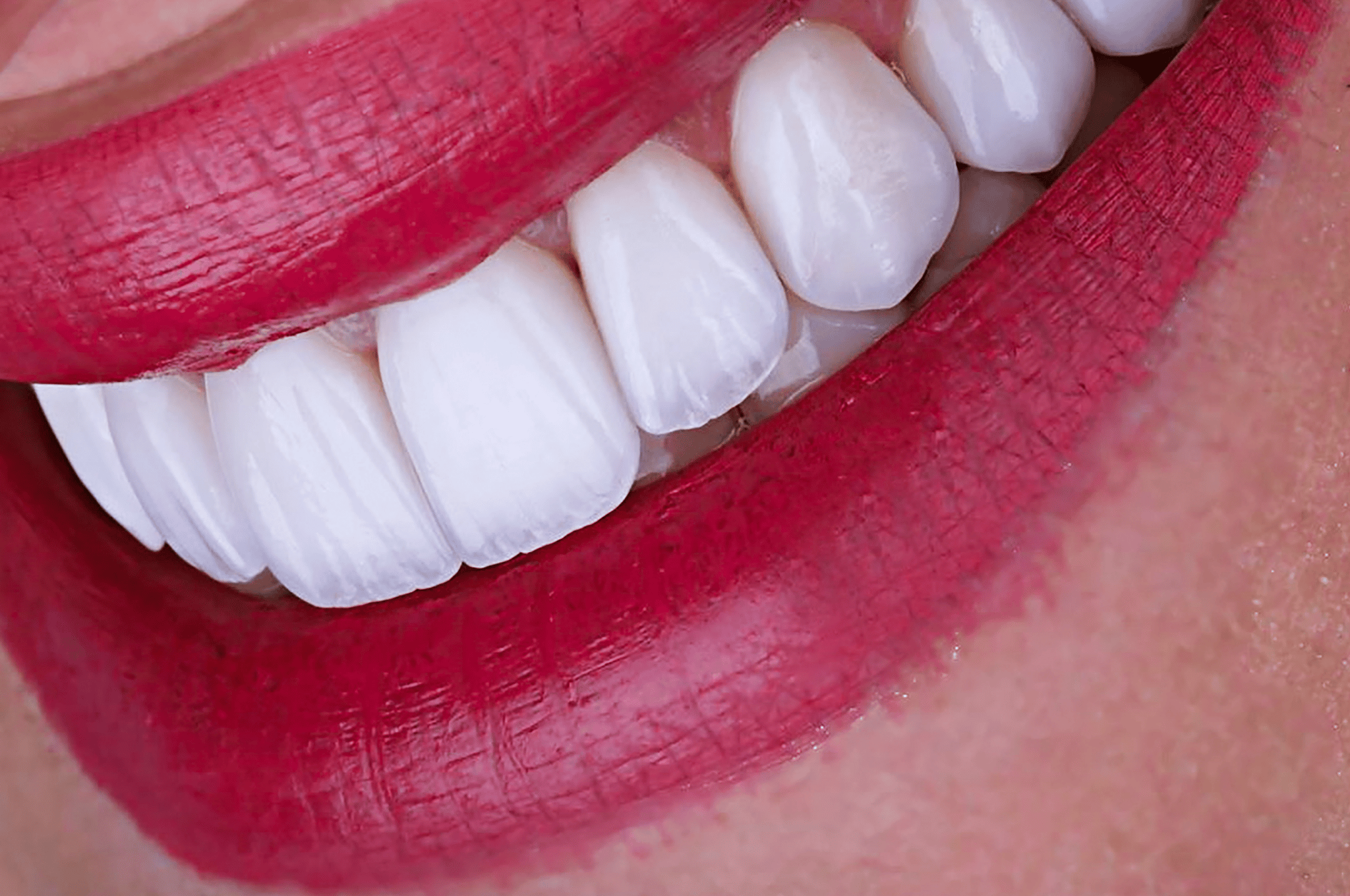 veneers-in-burlington