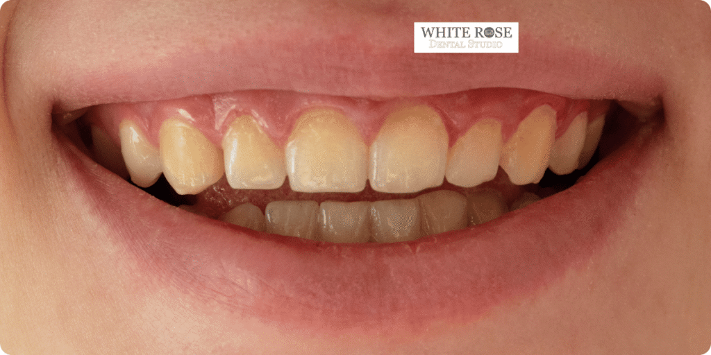 stained-teeth-burlington---white-rose-dental