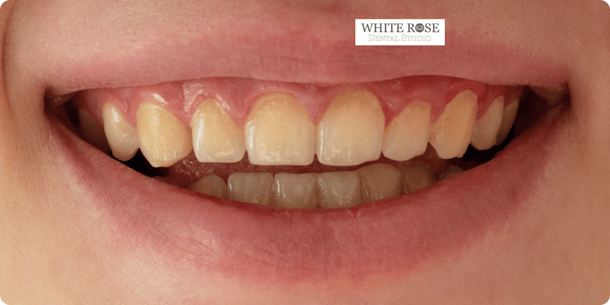 stained-teeth-burlington---white-rose-dental