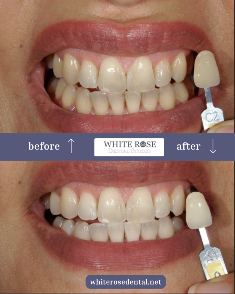 stained teeth