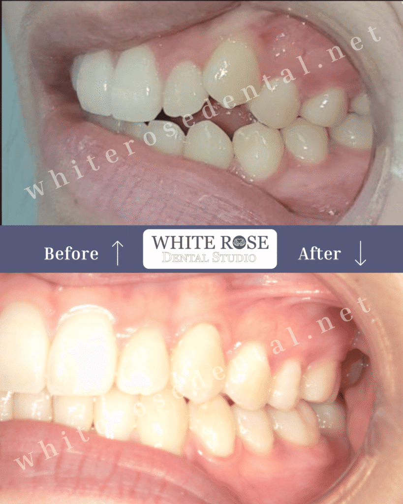 burlington-cosmetic-dentistry-smile-transformation-6