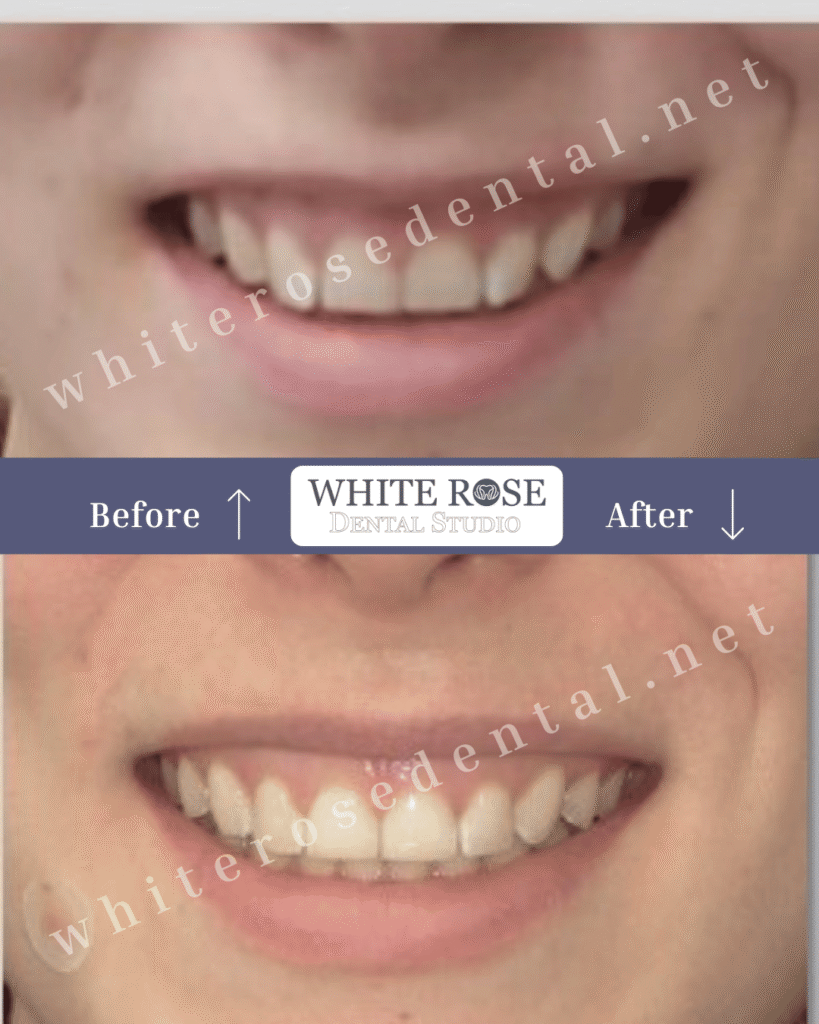 cosmetic-dentist-burlington-before-and-after-18