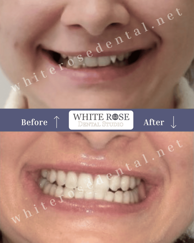 cosmetic-dentist-in-burlington-smile-transformation-8
