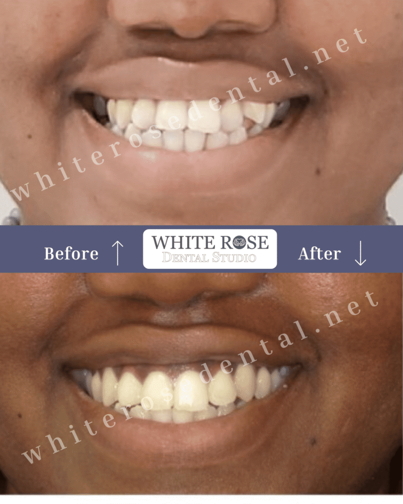 dentist in Burlington Smile Transformation #3