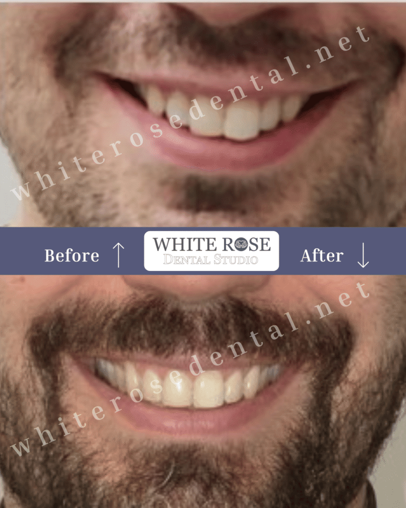 dentist-in-burlington-smile-transformation-5