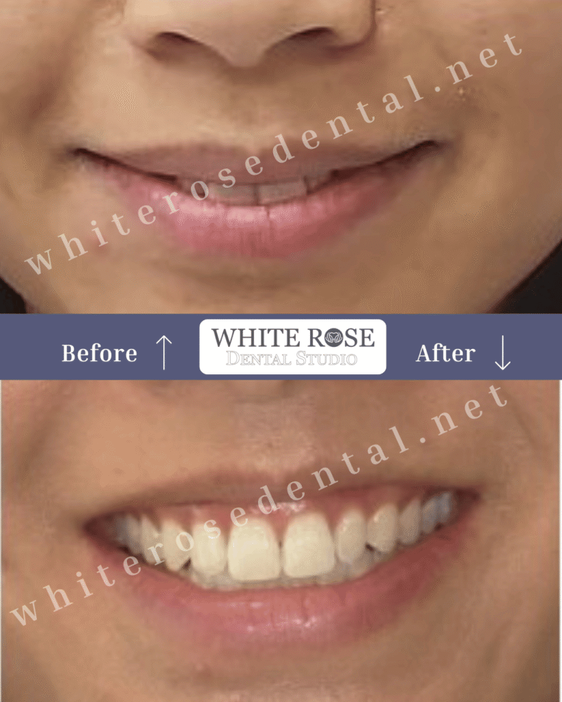 invisalign-burlington-ontario-smile-transformation-7