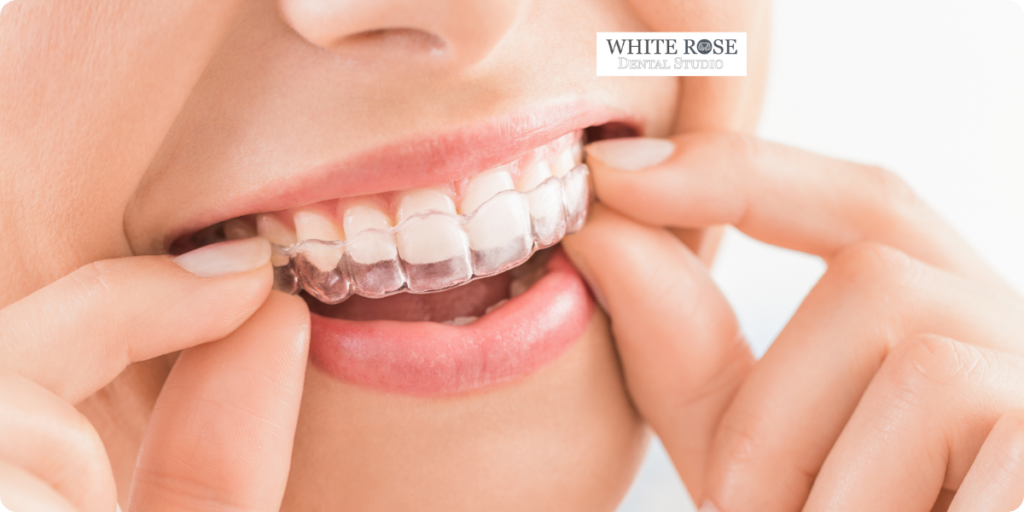 Invisalign in Burlington: What Patients Should Know Before Starting