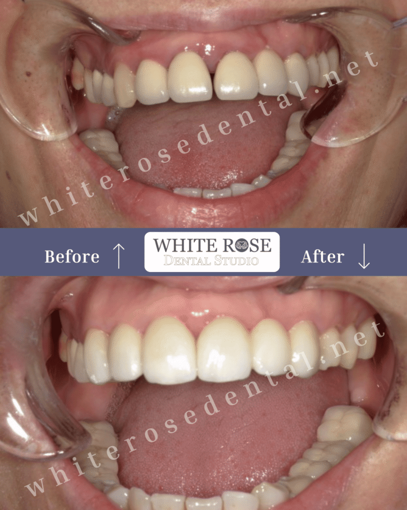 white-rose-dental-before-and-after-22
