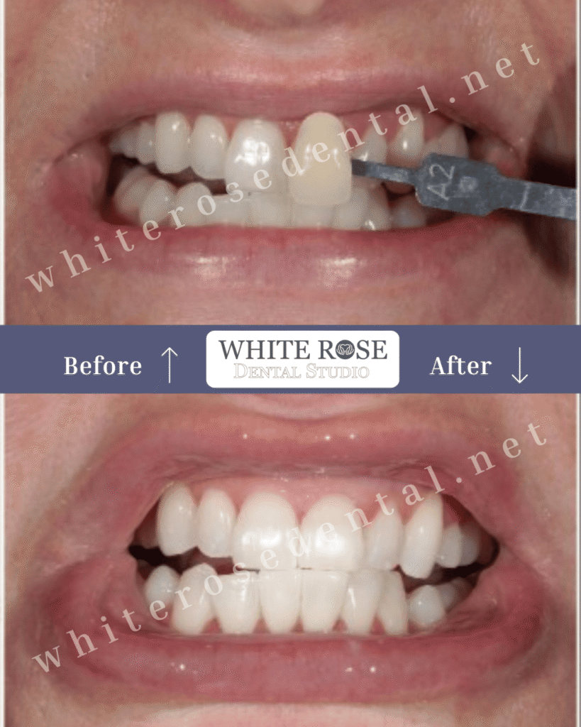 white-rose-dental-before-and-after-24