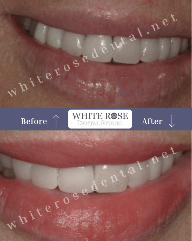 white-rose-dental-before-and-after-cosmeti-dentistry-20