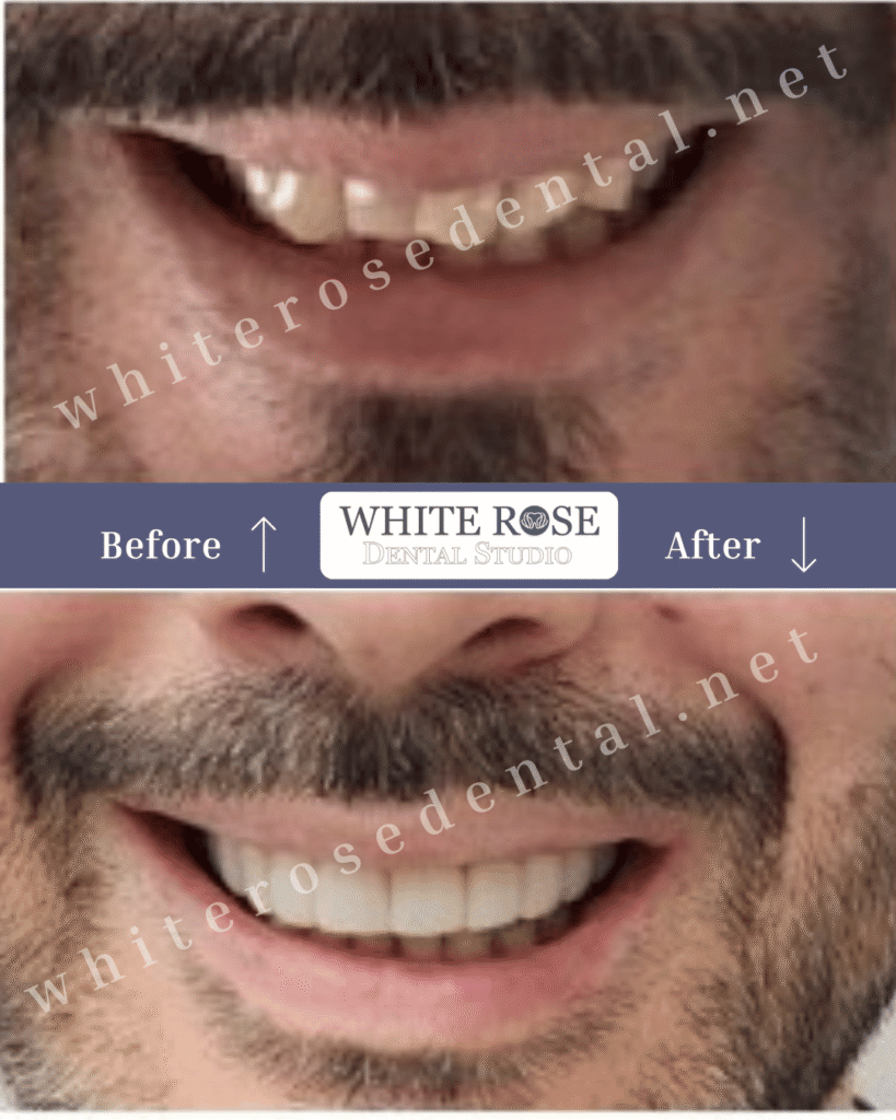 white-rose-dental-before-and-after-gallery-21