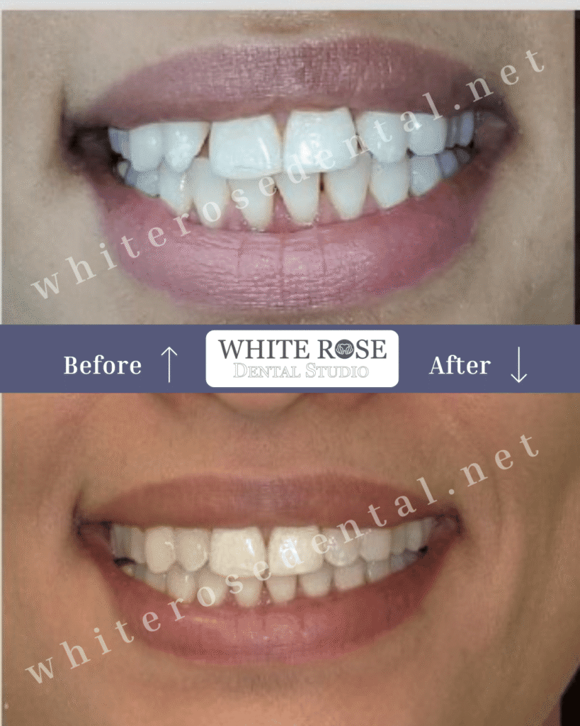 white-rose-dental-burlington-smile-transformation-15