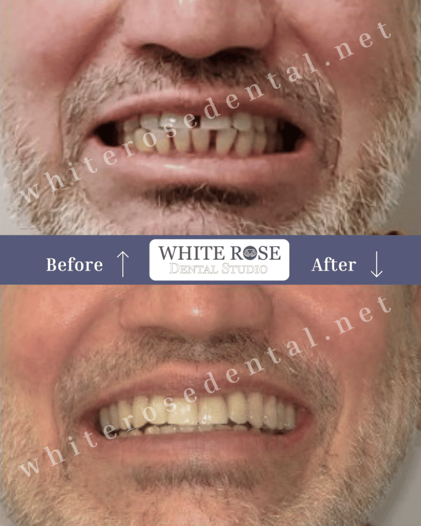 Hi Dr. Ali, hope you are doing well and excited about the upcoming clinic opening! As Burlington Dental Studio prepares for its big launch, I wanted to share an exciting update — your new website is now complete and our team is actively working on the full digital marketing setup to make sure everything is ready to drive new patients to your clinic from day one! 🌟 Your New Website is Live — Please Take a Look! 👉 https://burlingtondentalstudio.ca/ Your new website has been fully optimized for all devices: • 📱 Mobile — looks and performs perfectly on all smartphones • 📲 Tablet — fully responsive and easy to navigate on all tablet screens • 💻 Desktop — clean, professional, and conversion-focused on all desktop browsers Please take a moment to review the website on all your devices and let me know if you would like any changes or adjustments before we launch your marketing campaigns! Here is a full breakdown of everything we are currently working on for you: 🌐 Website & SEO Optimization Your brand new Burlington Dental Studio website is live and we are now optimizing every page for Google Search, local SEO, and AI-powered search platforms. This ensures that when new patients in Burlington search for a dentist, your clinic appears at the top of the results! 📢 Google Ads Campaign Setup We are building and preparing your Google Ads campaigns so they are ready to launch the moment Burlington Dental Studio opens its doors. Our goal is to drive new patient calls and inquiries from day one of your opening! 🤖 AI Search Optimization We are optimizing your online presence so that AI platforms like ChatGPT, Google Gemini, and Perplexity can find, understand, and recommend Burlington Dental Studio when patients ask questions like “Who is the best dentist in Burlington?” or “Which dental clinic is accepting new patients near me?” 📝 Website Blog Content Research Our team is researching and preparing SEO-optimized blog content specifically tailored for Burlington Dental Studio. These blog articles will help drive organic traffic to your website and strengthen your Google search rankings over time. 📱 Custom Social Media Layout Design We are creating fully custom branded social media post designs for Burlington Dental Studio across Facebook, Instagram, and Google My Business — ensuring your clinic looks professional, consistent, and eye-catching across all platforms from day one! 📍 Google Business Profile Optimization We are fully optimizing your Google Business Profile so Burlington Dental Studio appears prominently on Google Maps when new patients search for a dentist in Burlington and surrounding areas. 📞 CallRail Call Tracking Your call tracking is fully set up and active so we can monitor and measure every phone call generated from your marketing campaigns. Dr. Ali, by the time Burlington Dental Studio opens its doors, your entire digital marketing presence will be fully built, optimized, and ready to start attracting new patients immediately! I will keep you updated as we continue to progress through each step. Please don’t hesitate to reach out anytime if you have any questions — I am always here for you! Looking forward to an incredible launch for Burlington Dental Studio! 🚀 Best, Alex Founder, Dental Marketing Experts Inc.